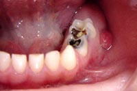 Picture of infected tooth and abcess.